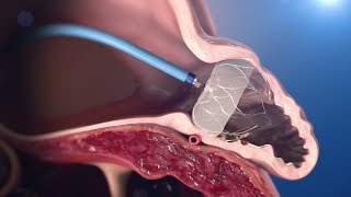 WATCHMAN Implantation Technique [upl. by Seys]