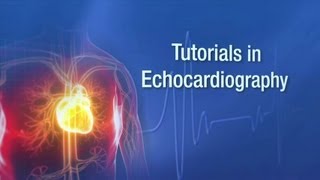 Transesophageal Echocardiography Infective Endocarditis [upl. by Nahgeem]