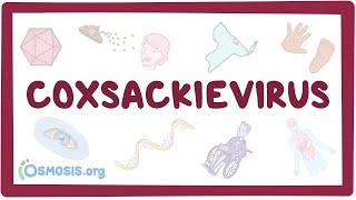 Coxsackievirus  an Osmosis Preview [upl. by Nahn177]