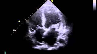 Echocardiography Essentials Mastering the apical fourchamber view 4CV [upl. by Atoel]