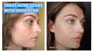 The 101 On InvisiScar Resurfacing Treatment  Reduce Acne Scars  Murad Skincare [upl. by Ehtylb810]