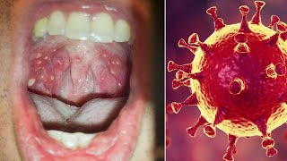 Coxsackie Virus Incubation Period Symptoms Treatment amp Rash [upl. by Marmion]