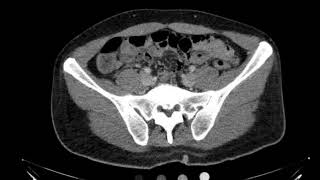 Fournier gangrene CT Axial [upl. by Eilrebma344]