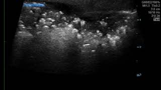 Bedside Ultrasound for the Rapid Diagnosis of Fournier’s Gangrene US JETem 2019 [upl. by Frankel]