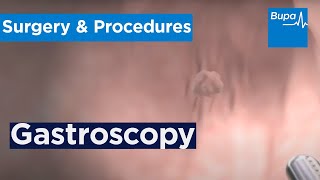 How a gastroscopy is carried out  Bupa Health [upl. by Okeim74]