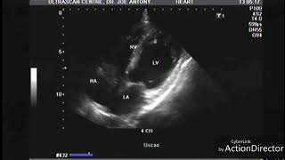 Myocardial infarction echocardiography [upl. by Nodnahs106]