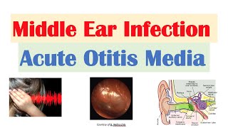 Ear infection home remedies plus treatments [upl. by Tsan]