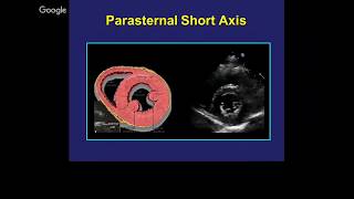 Mastering important TEE views transesophageal echocardiography [upl. by Aical]