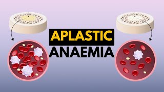 Aplastic Anaemia Causes Signs and Symptoms Diagnosis and Treatment [upl. by Biancha]