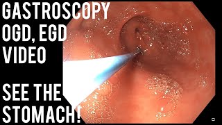 Gastroscopy  OGD  See inside the stomach [upl. by Delanty]