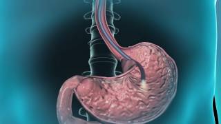 Learn about gastroscopy [upl. by Ydur529]