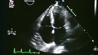 Atrial Fibrillation On Echocardiogram [upl. by Denyse11]