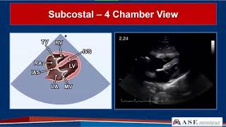 Ultrasound Guided Placement of the Accucath 225quot [upl. by Bradstreet]