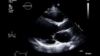 Ischemic Cardiomyopathy 2D Echocardiogram [upl. by Olrak702]