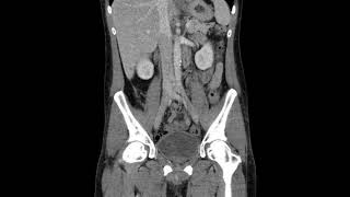 Fournier gangrene CT Coronal [upl. by Ellac718]