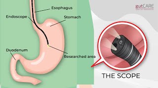 Preparing For Your Gastroscopy OGD  GUTCARE [upl. by Gasperoni]