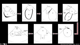 Echocardiography to Assess MitralValve Leaflets  NEJM [upl. by Acsicnarf]