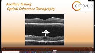 OCT in Plaquenil Screening [upl. by Ellenrahc]