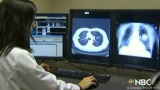 Using CT Scans to Screen for Lung Cancer [upl. by Nnarual]