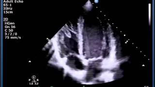 Echocardiography for Surgeons Part I Standard Views [upl. by Neeruam732]