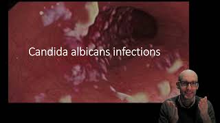 Candida albicans infections [upl. by Pinette287]