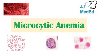 Microcytic Anemia amp Causes Iron Deficiency Thalassemia Anemia of Chronic Disease Lead Poisoning [upl. by Burn]